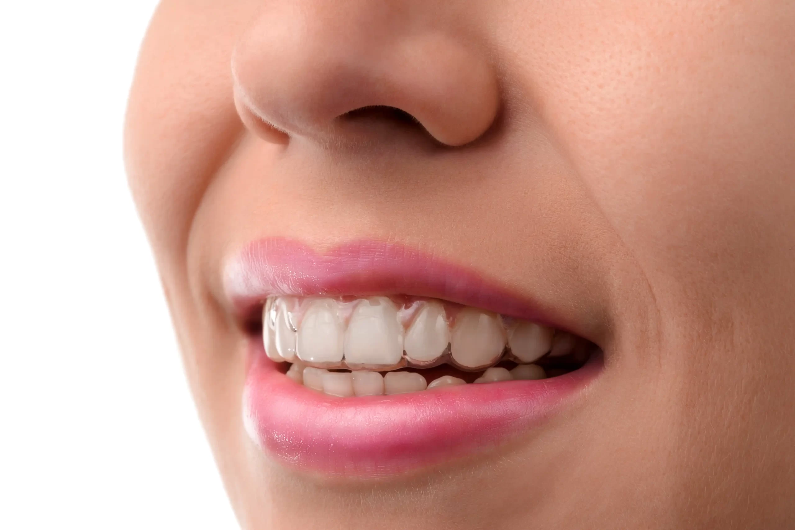 قیمت الاینر دندان در زعفرانیه